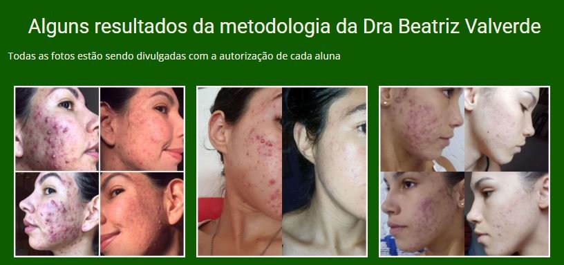 Como funciona a Comunidade Antiacne e seus módulos