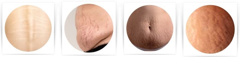 Como funciona Camuflagem de Estrias e seus módulos